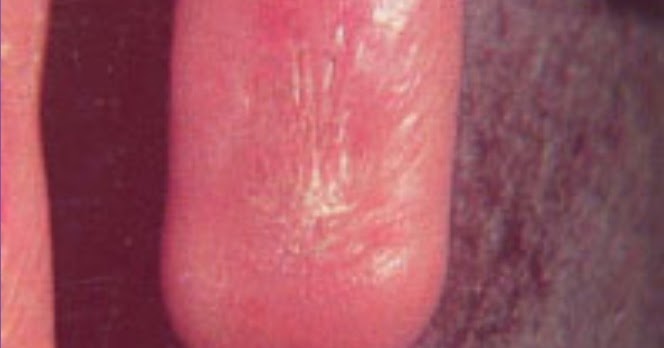 La psoriasis y las golosinas